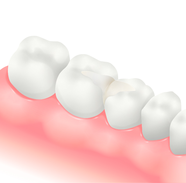 e-max (二ケイ酸リチウム)