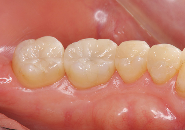 メタルフリー治療