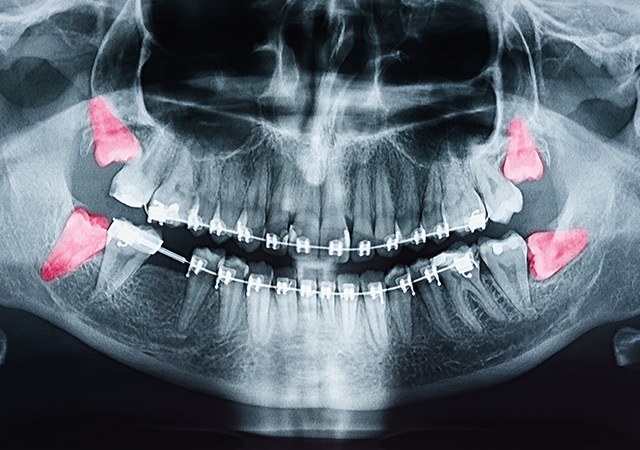 親知らずの抜歯
