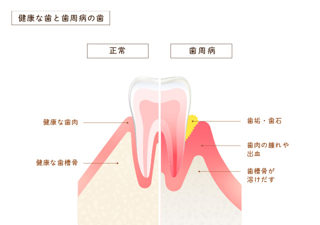 健康な歯と歯周病の歯